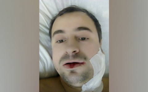 Рот зашили проволокой: стоматологи случайно сломали ярославцу челюсть